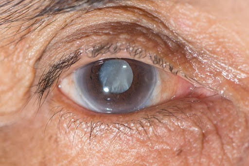Glaucoma